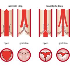 aortaklep stenose normale aangetaste klep open gesloten bloedvaten slagader richting bloed infographic illustratie