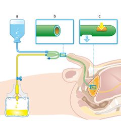 gesloten blaasspoelsysteem, katheter, blaas, spoelen, doorsnede, onderlichaam man, urine, illustratie