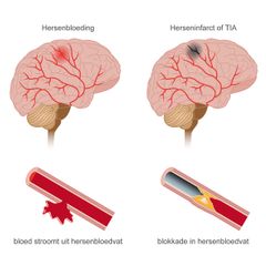 hersenbloeding Tia herseninfarct bloedvat lekke ader bloed blokkade hersenen illustratie doorsnede anatomisch medisch educatief