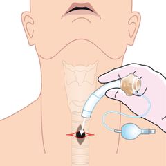 canule inbrengen trachea patiënt hals keel luchtpijp ademhaling hand incisie illustratie