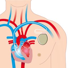 pacemaker hart slagaders aders bloedvaten menselijk lichaam illustratie